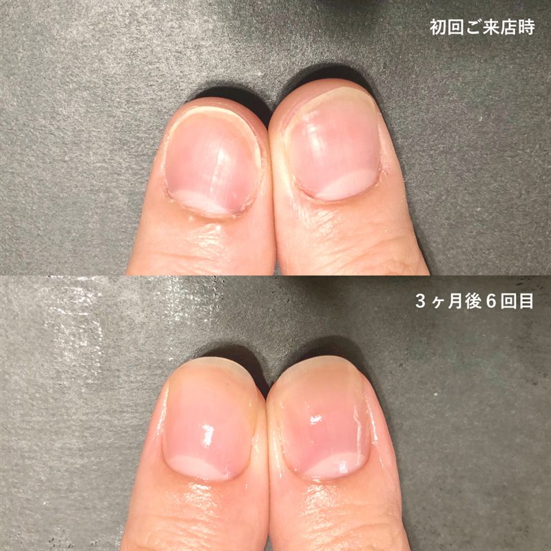 自爪育成の症例1。初回ご来店時と3ヶ月後の比較