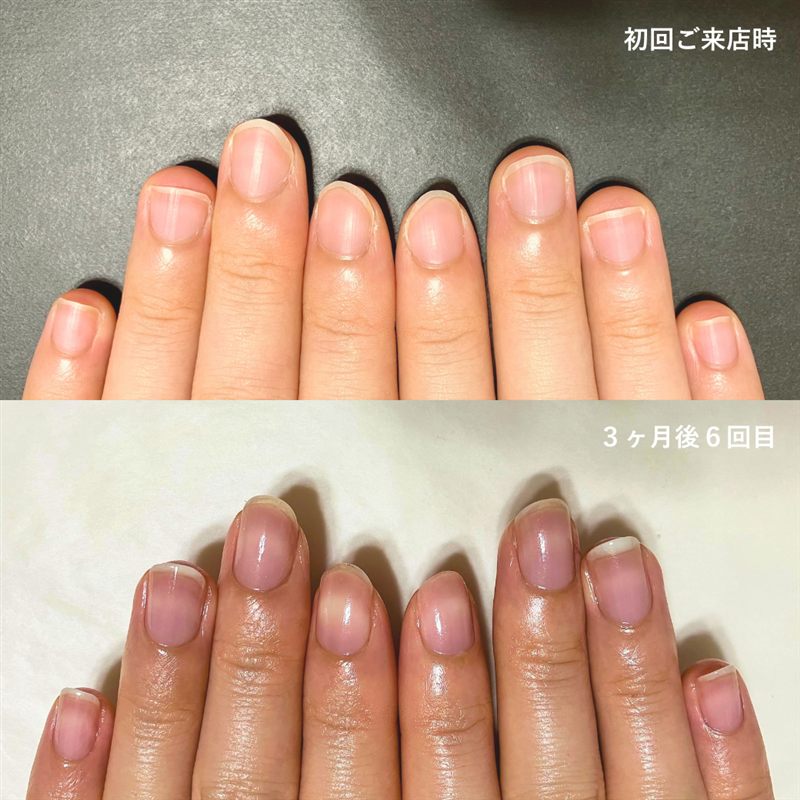 自爪育成の症例写真。初回ご来店時と3ヶ月後6回目の比較