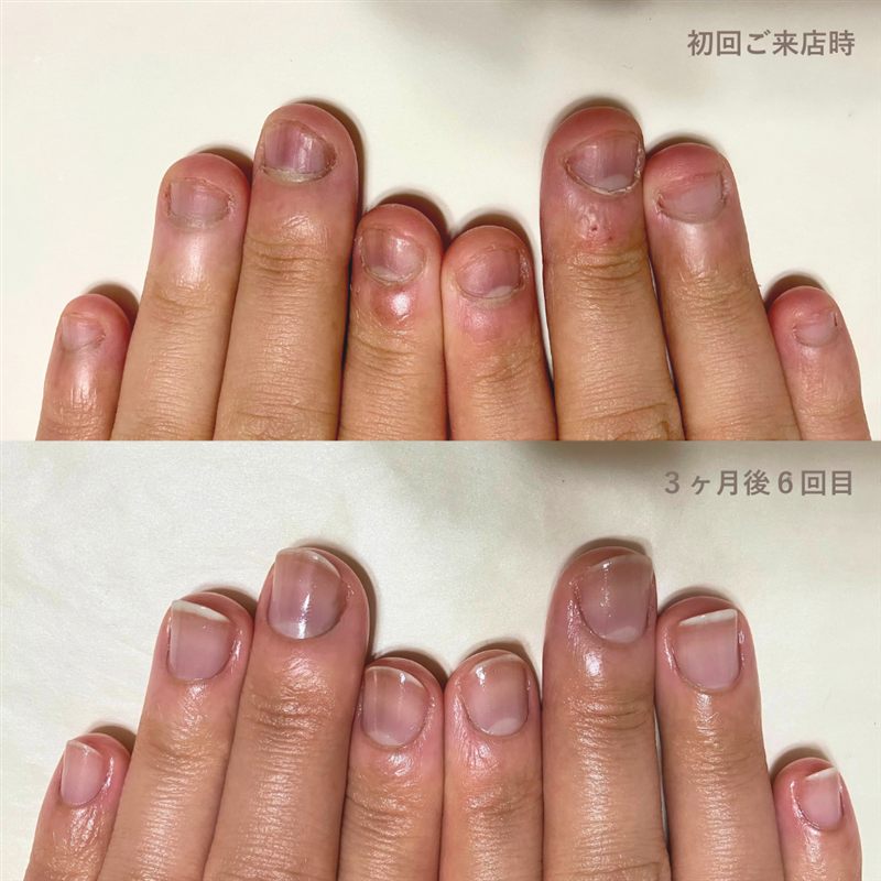 自爪育成の症例写真。初回ご来店時と3ヶ月後6回目の比較