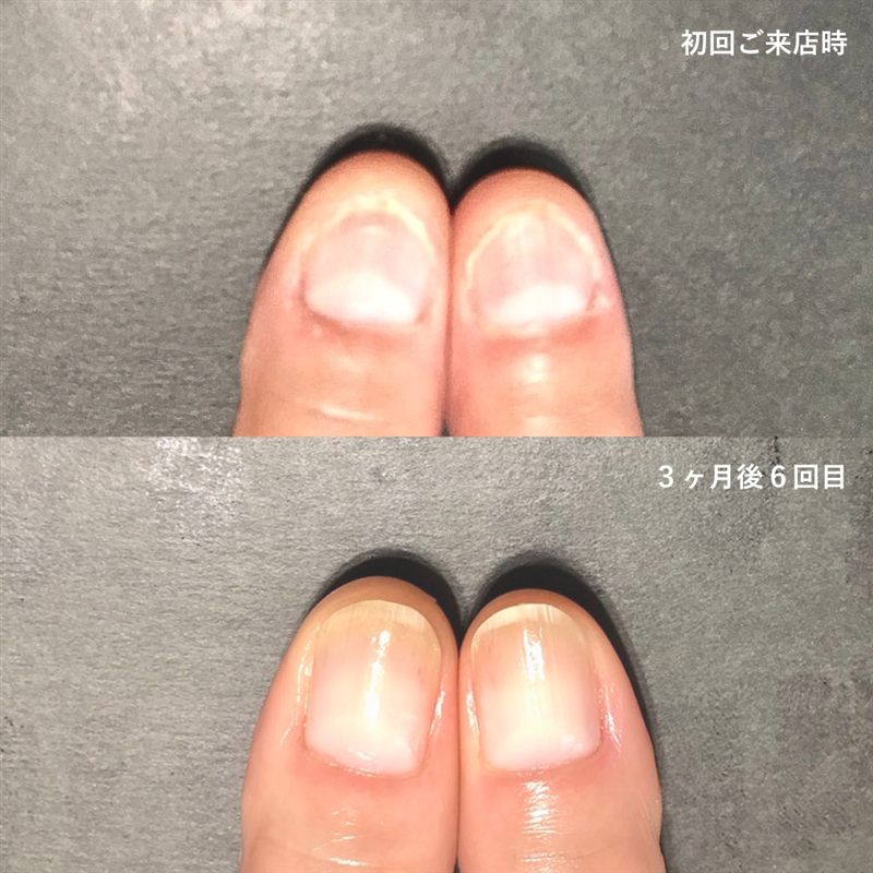 自爪育成の症例4。初回ご来店時と3ヶ月後の比較