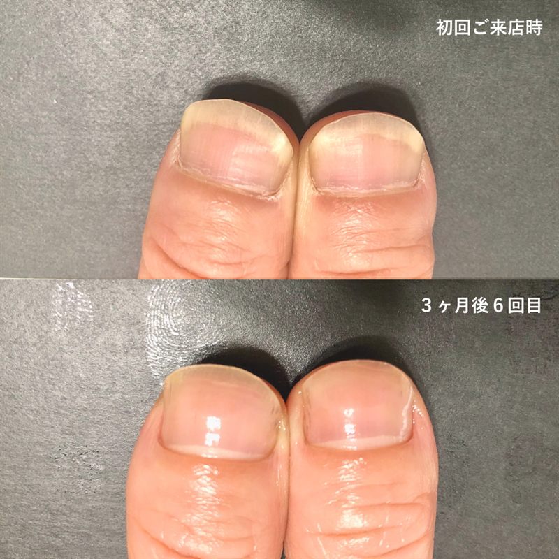 自爪育成の症例5。初回ご来店時と3ヶ月後の比較
