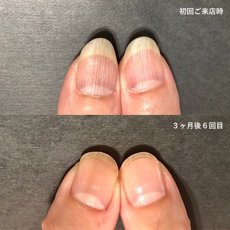自爪育成の症例6。初回ご来店時と3ヶ月後の比較