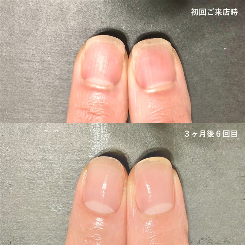 自爪育成の症例7。初回ご来店時と3ヶ月後の比較