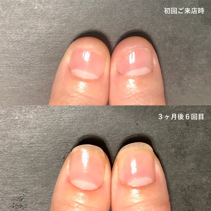 自爪育成の症例8。初回ご来店時と3ヶ月後の比較