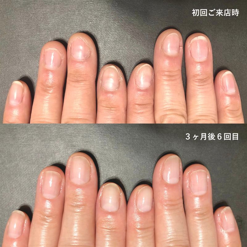 自爪育成の症例写真。初回ご来店時と3ヶ月後6回目の比較